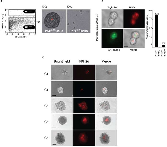 Less differentiated human breast tumors