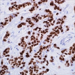 GATA3 (L50-823) on infiltrating ductal carcinoma of the breast