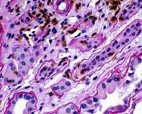 Lymphocytes are clearly identified, and their precise location in relation to tubular basement membranes is easy to determine on the PASH/T-cell stain. UCHL-1/PASH 400x