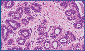 Microwave fixed breast tissue stained with H&E. Nuclear detail is improved. 200X