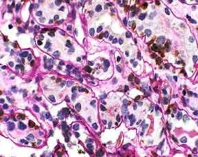 Tubulitis in the renal biopsy. Lymphocyte cytoplasm stains brown. Tubular borders are clearly delineated. UCHL-1/PASH 400x