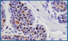 Routinely fixed and processed breast tissue stained with IHC for estrogen receptor protein. Some background staining is noted in intercellular areas and ductal lumens. 400X