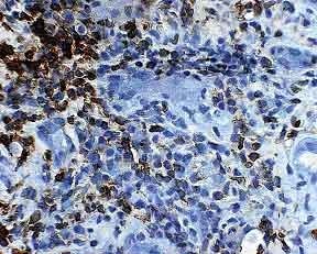 It is difficult to identify borders of tubules on a standard lymphocyte stain; determining the location of the lymphocytes (outside versus inside the tubular basement membranes) can be problematic. LCA 400x