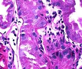 Distinguishing lymphocytes from tubular cells can be difficult on a standard PASH stain. PASH 400x