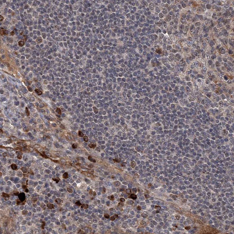 Immunohistochemical staining of a human colon with adenocarcinoma. The anti-GPR132 antibody (Cat. No. HPA029695) binding is visible in brown.