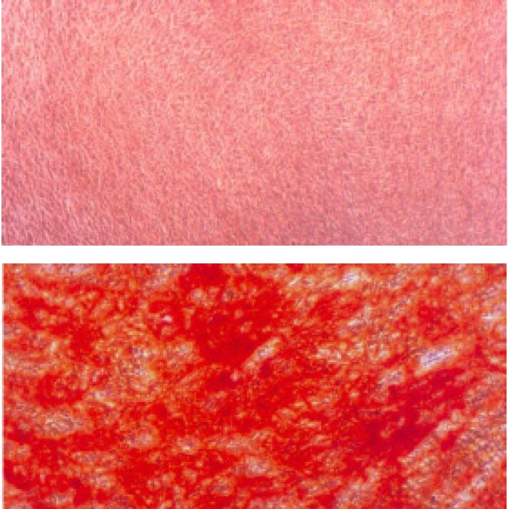 MSC cells were cultured for 12 days in PromoCell MSC Growth Medium 2 for the negative control (upper panel) or MSC Osteogenic Differentiation Medium for the differentiation sample (lower panel). In contrast with the negative control, the mature osteoblasts differentiated from MSC show intense redorange staining of mineralized bone matrix. Note also the concentration of Alizarin Red S staining in some of the larger bone nodules.