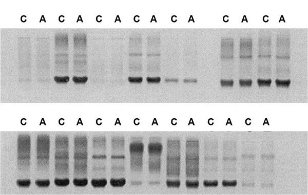 Results of electrophoretic resolution of free immunoglobulin light chains